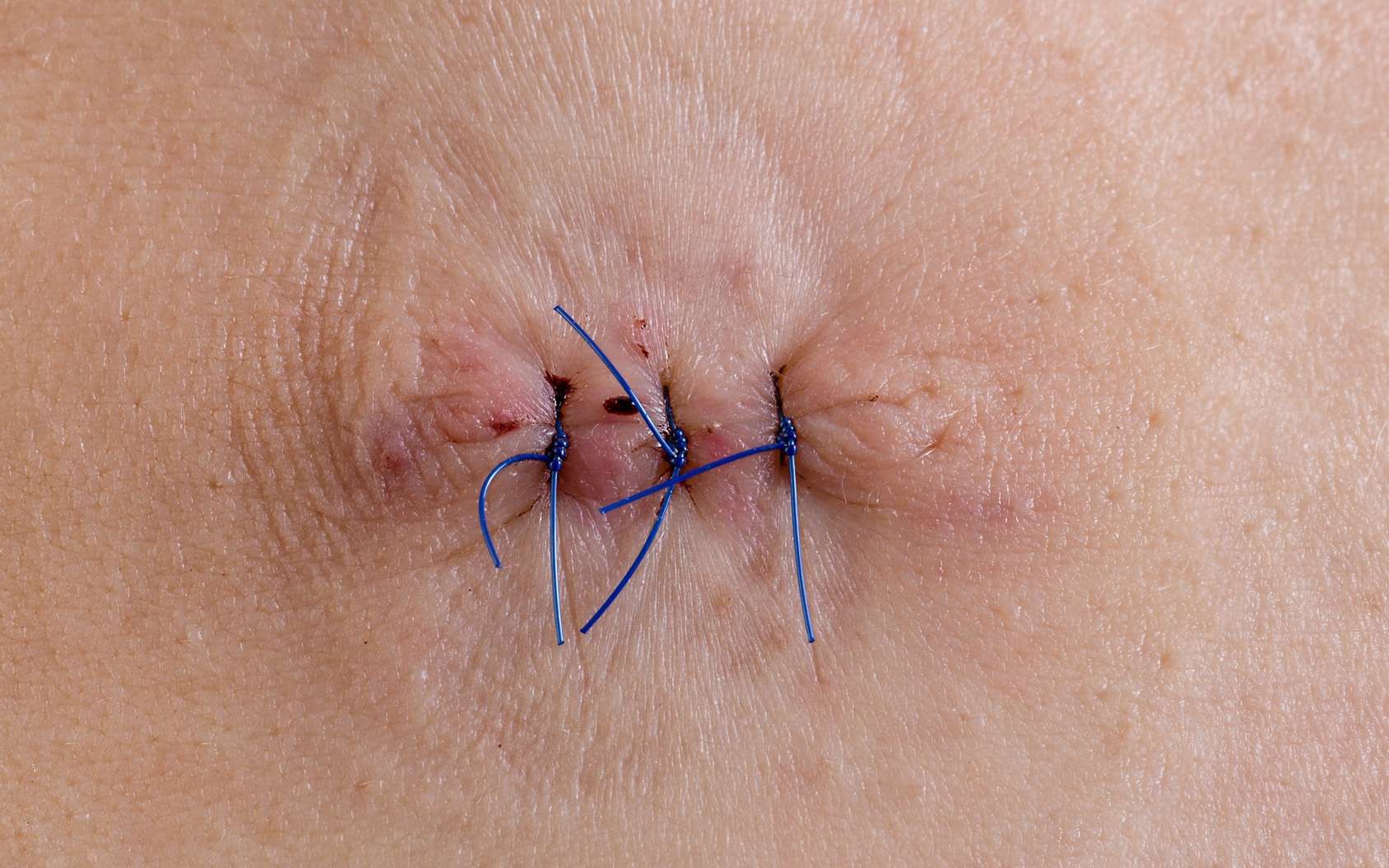 Points de suture : coller plutôt que recoudre pour refermer les plaies ?