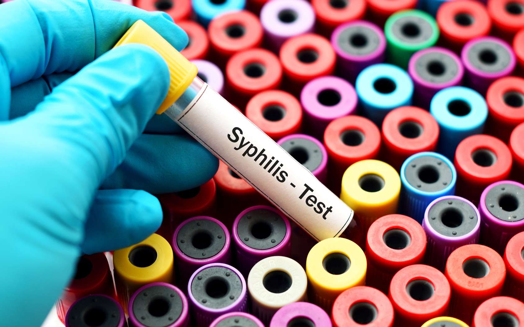 Forte progression de la syphilis en Europe : 70 % de cas en plus depuis 2010