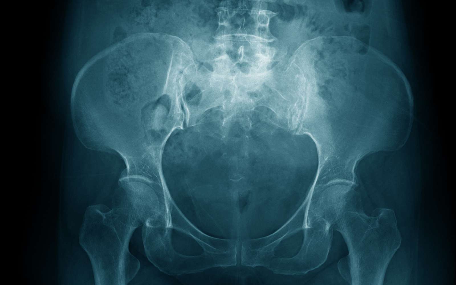 Ostéoporose : 28 % des hommes de 35 à 50 ans sont concernés