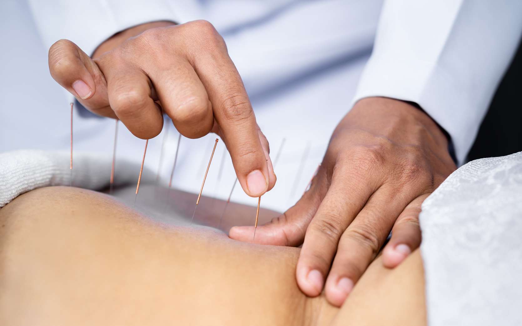 L'acupuncture en plus des traitements : effets réels ou contextuels 