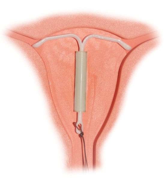 Le stérilet, un contraceptif bien plus efficace que la pilule