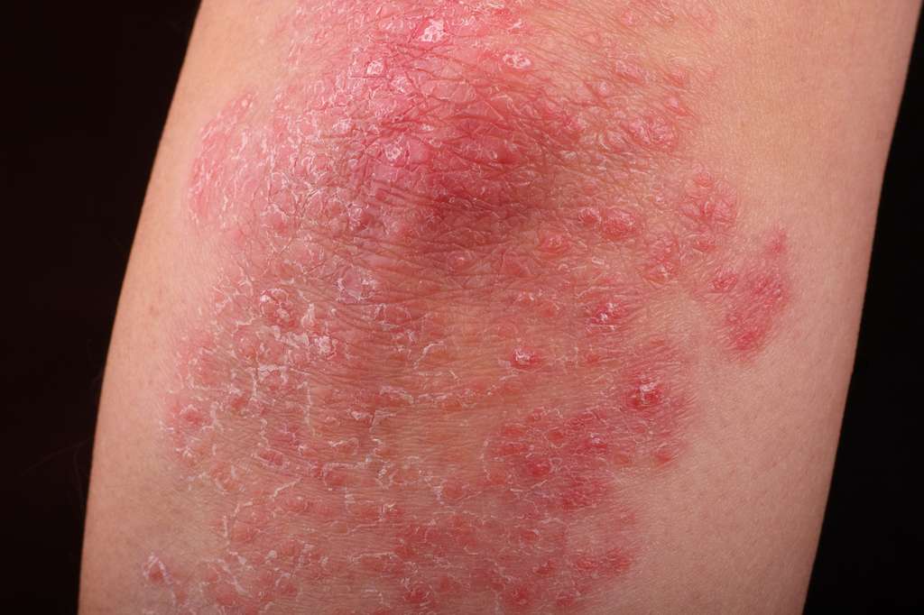 Psoriasis : un remède trouvé grâce à la fourmi de feu ?