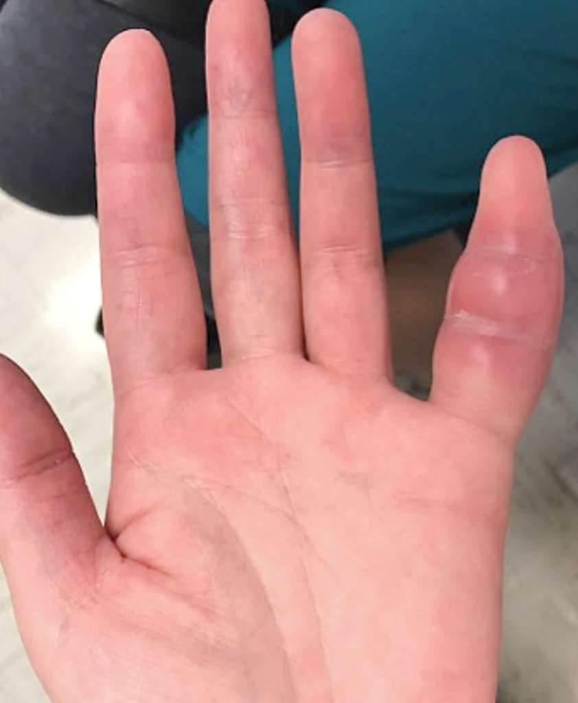 Patient hors norme : son petit doigt est gonflé, c'est la tuberculose