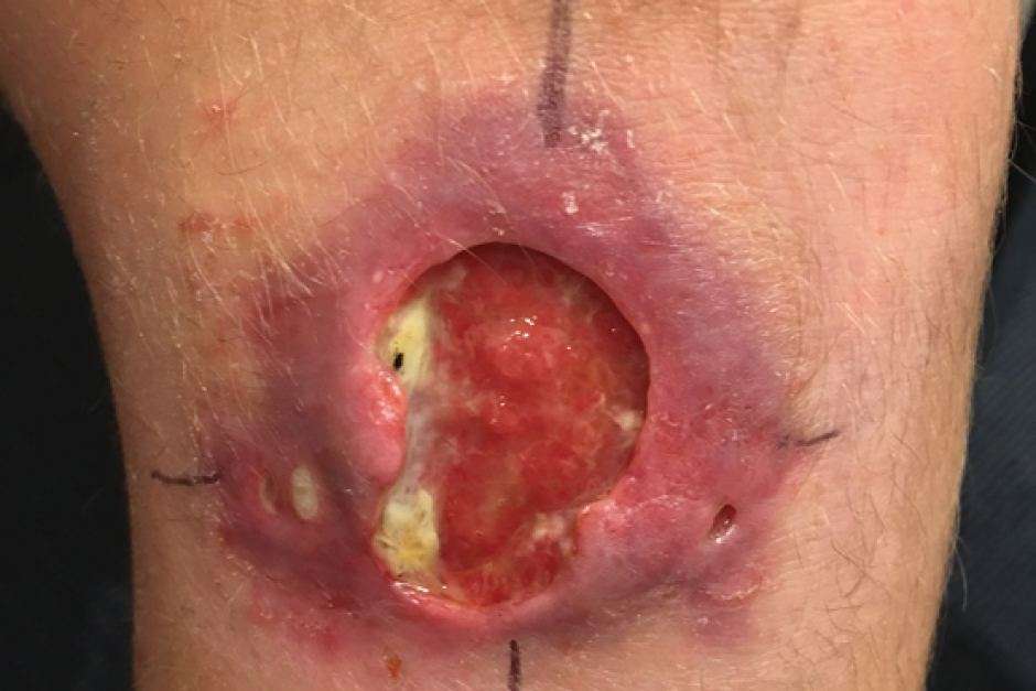 Recrudescence d'une bactérie mangeuse de chair en Australie