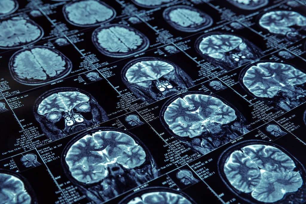 Alzheimer aurait un lien avec la santé bucco-dentaire
