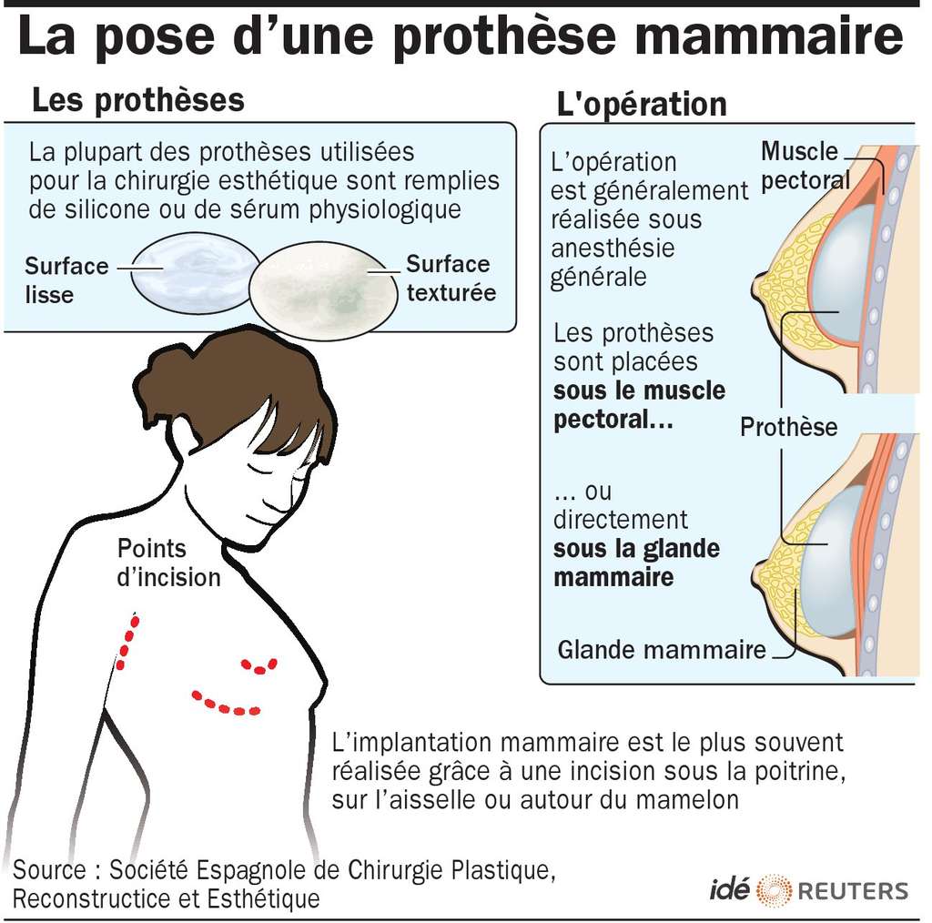 On estime Ã  environ 500.000 le nombre de FranÃ§aises ayant subi une opÃ©ration de chirurgie pour se faire poser un implant mammaire. Cette illustration explique les procÃ©dÃ©s utilisÃ©s. Â© IdÃ©