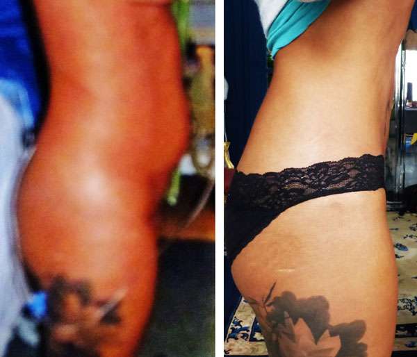 La technique de la liposuccion. © Dr Mitz, tous droits réservés