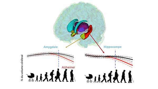 Alzheimer : le cerveau se modifie avant l’apparition des premiers symptômes