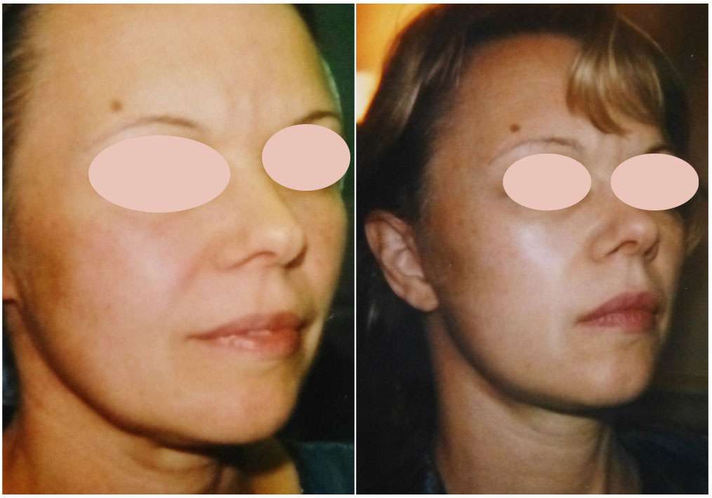 À gauche, patiente jeune demandeuse de rétablissement de l’ovale du visage par chirurgie efficace. À droite, résultat obtenu par microlift six mois après l'opération. © Dr Mitz, tous droits réservés 