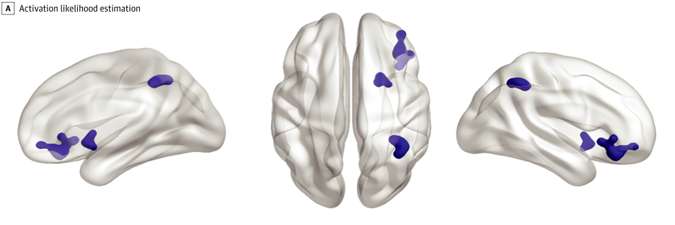 La cartographie des zones cérébrales sous-activées chez les personnes anxieuses ou dépressives. © Janiri et al.