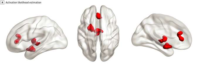 La cartographie des zones cérébrales sur-activées chez les personnes anxieuse ou dépressives. © Janiri et al.