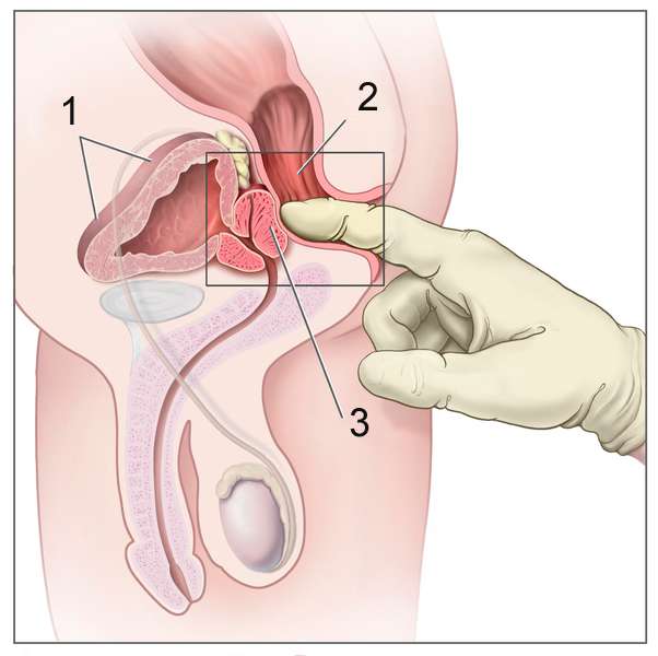 Schéma de toucher rectal (1) la vessie, (2) le rectum et (3) la prostate. © Wikimédia, CC by-sa 3.0